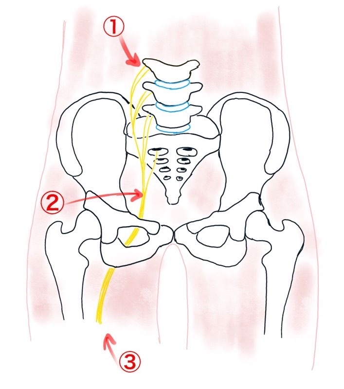 sciatic_pain