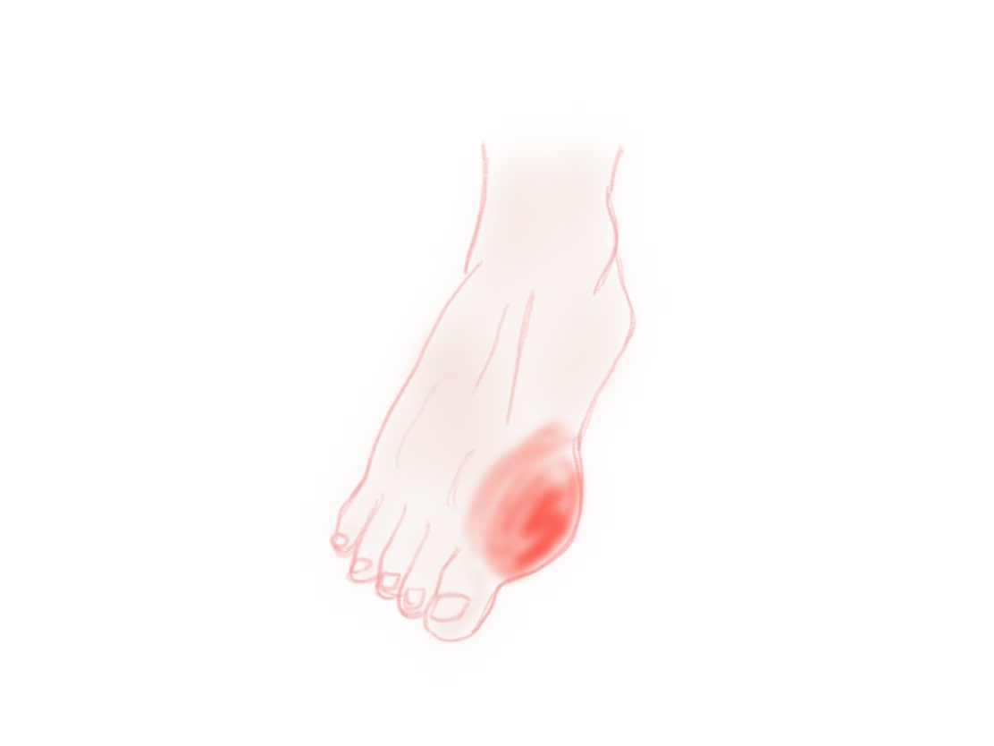 gout